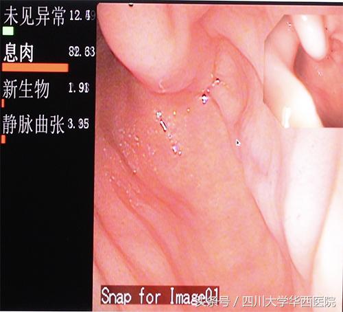 鼻息肉手術視頻直播，現代醫療技術的透明展示與解析